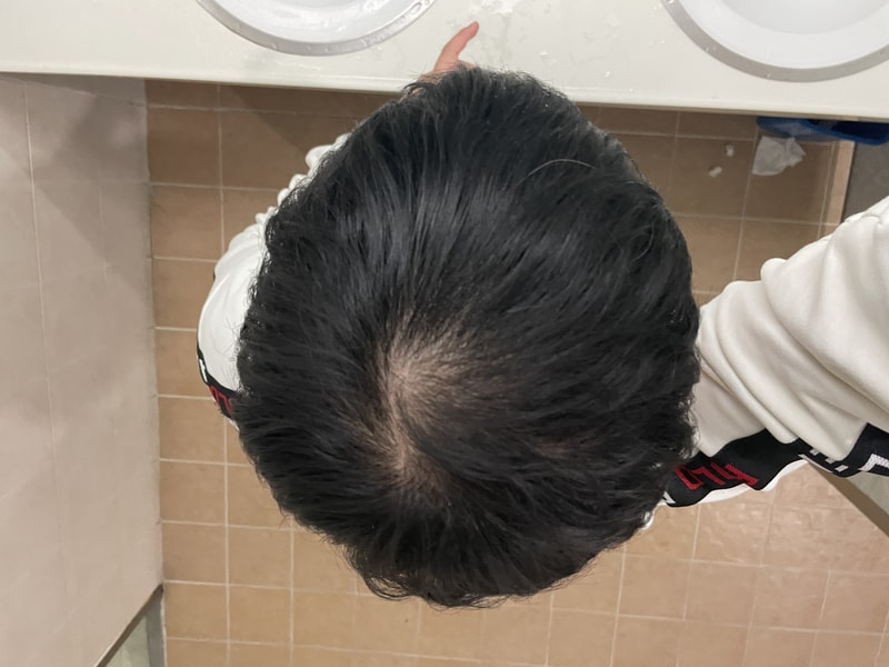 탈모 치료 어디서 받아야 할까요? 혈류개선 쪽으로 희망