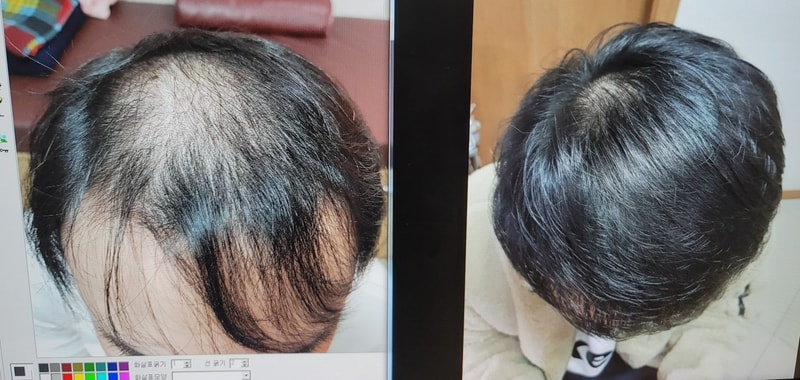 薬の服用で克服しています