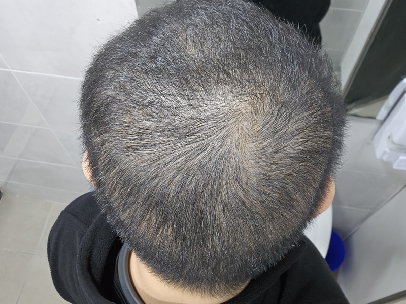 탈모인생 17년  약 한번도안먹음..