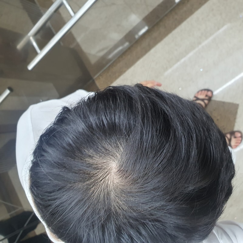 去医院一看 说不是脱发