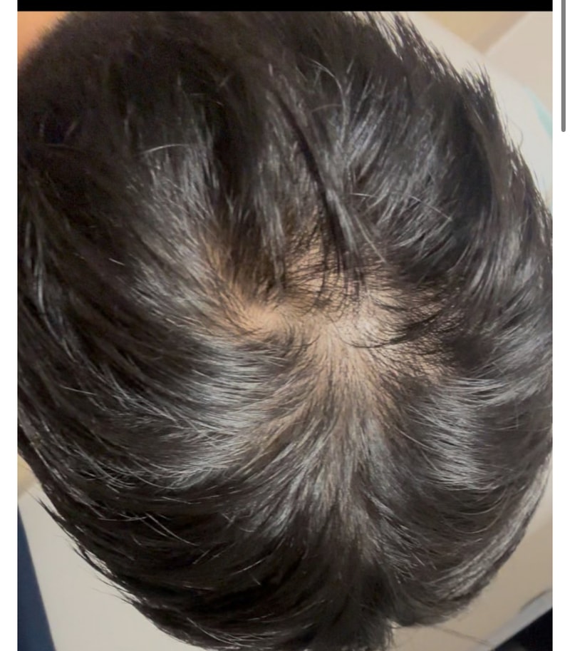 22살입니다. 탈모인가요?? 3번째 사진은 2년전입니다