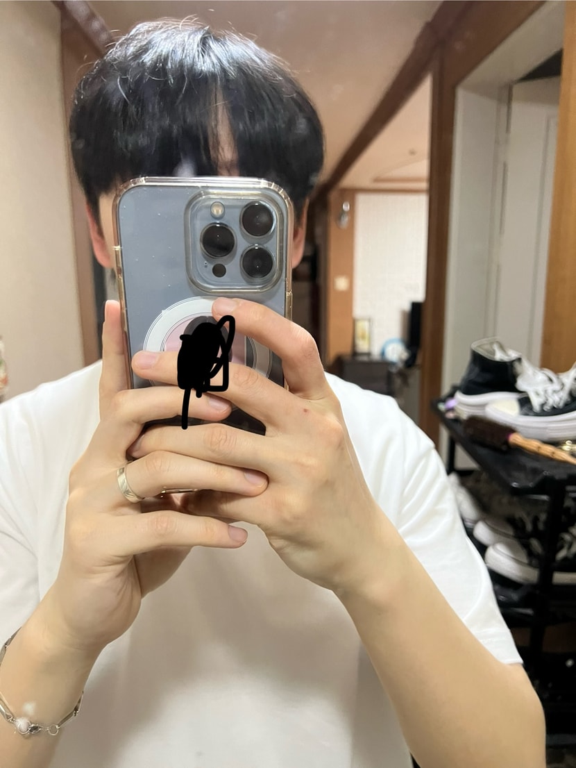 앞머리 내리면 저부분만 비어있내요 스트레스 받아서 저 부분만모발이식 가능할까요?