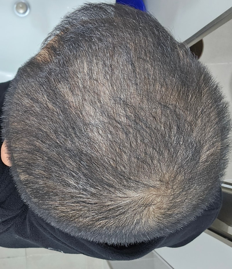 整体会变薄。吃药也有效果吗？头型脱发？