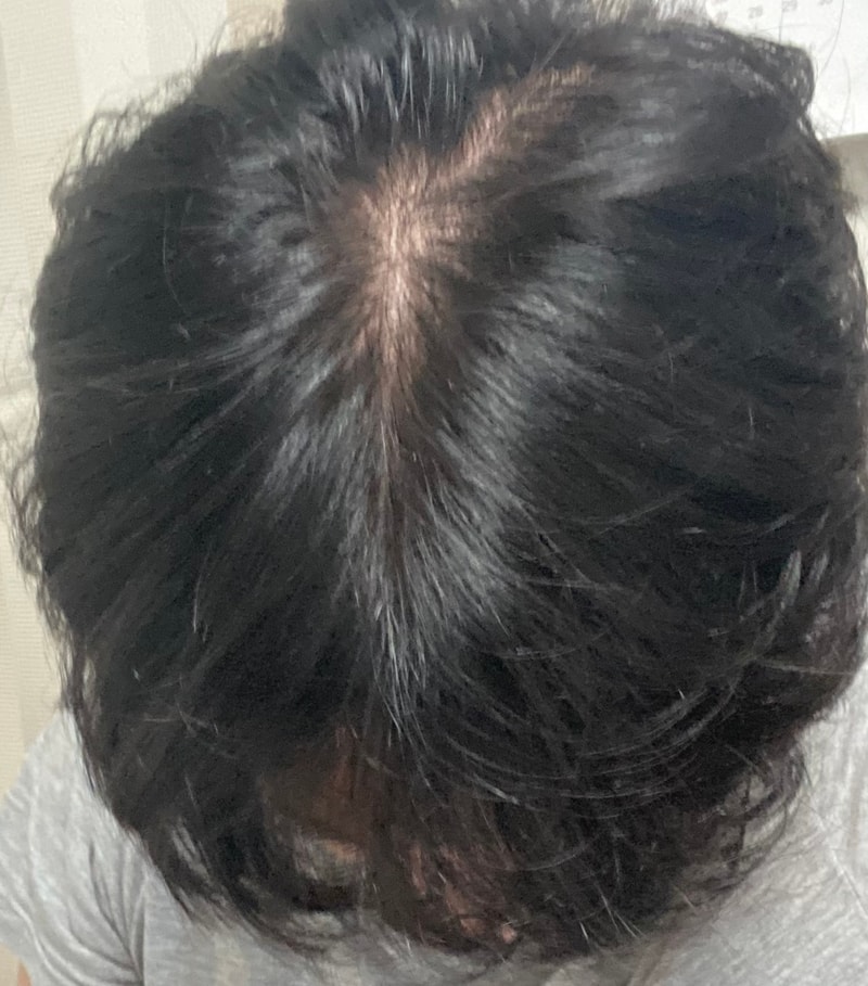 탈모약 변경과 변화