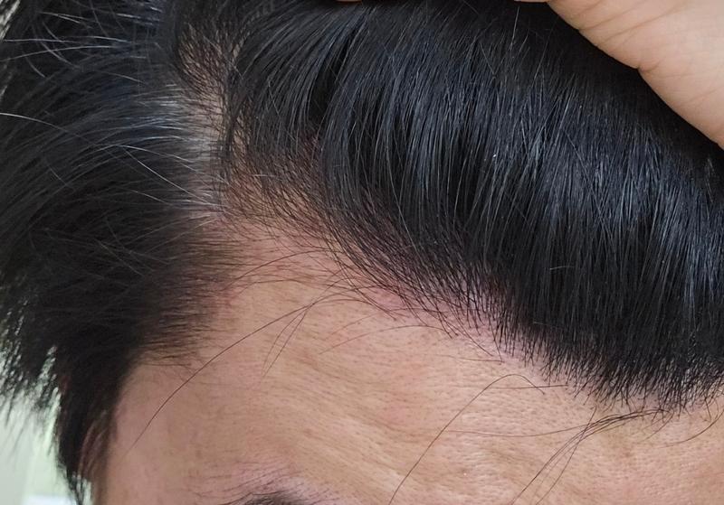Pondation and Density... Continued even after hair transplantation