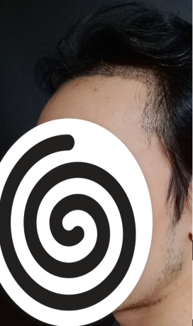 수술 후 3