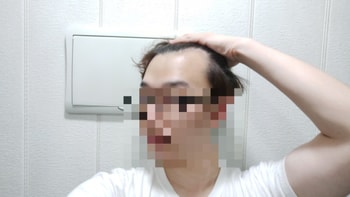 수술 전 2번