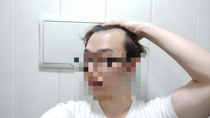 수술 전 2번