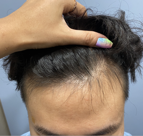 m字型脱发以毛发移植为答案