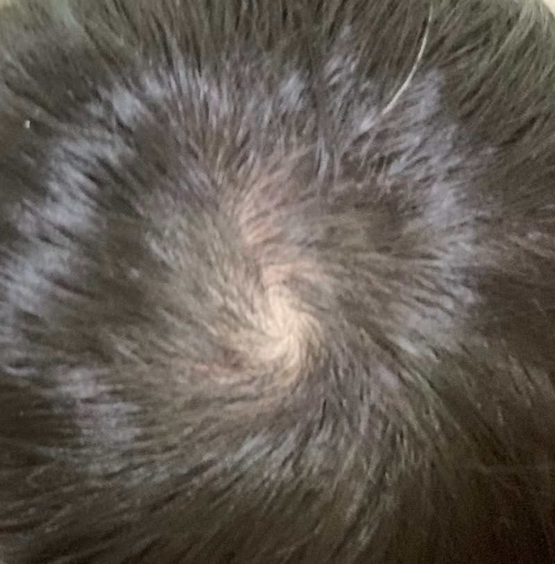 피나3년 아보 2년 좀 안된상황 24살 정수리 상황