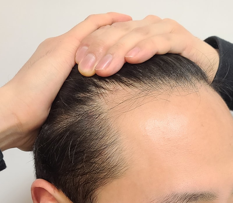 I will post the review of the 7th day of the 3353 hair incision hair transplant.
