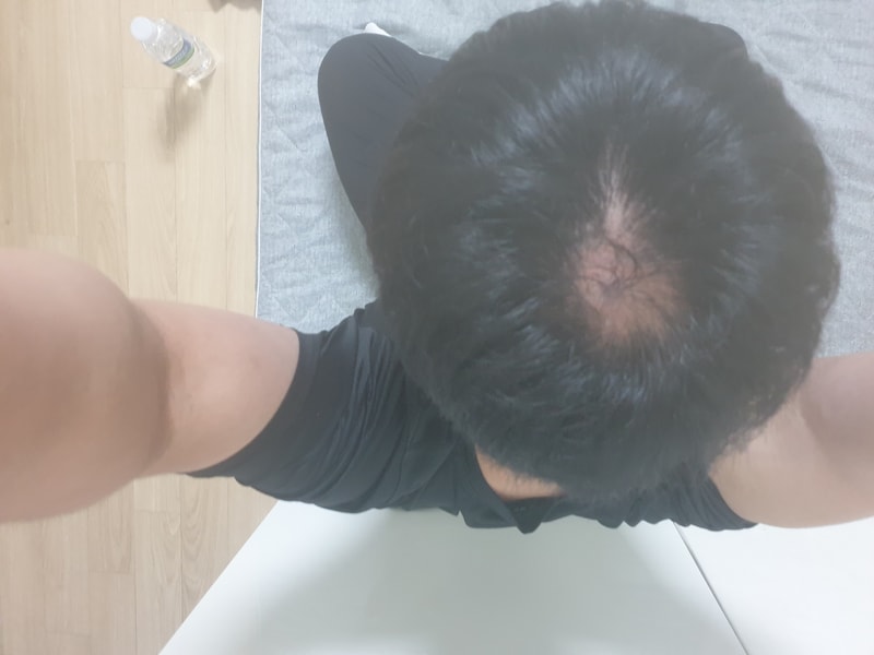 아보다트를 끊었는데도 발기가 안 돼요