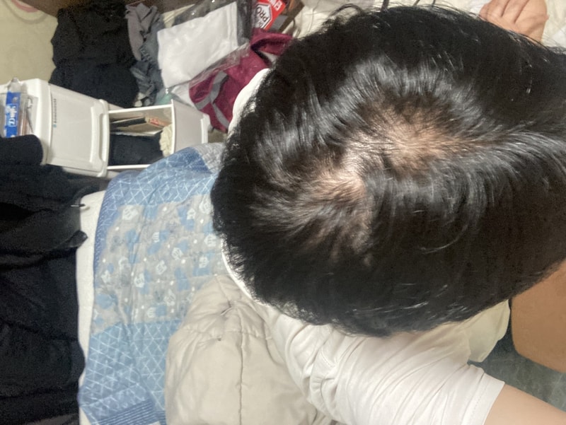 프로페시아 거의 7년째 먹고있습니다