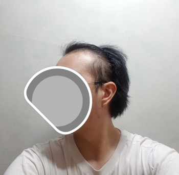 수술 전 좌측
