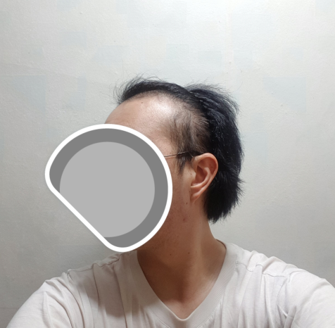 수술 전 좌측
