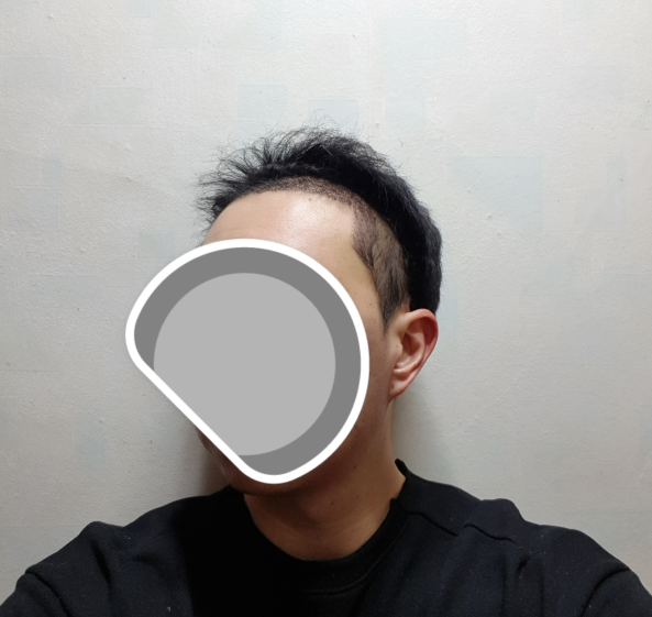 수술후 좌측