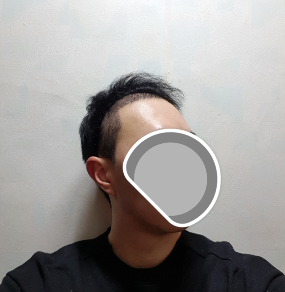 수술후 우측
