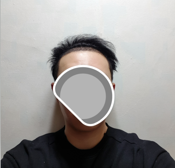 수술후 정면
