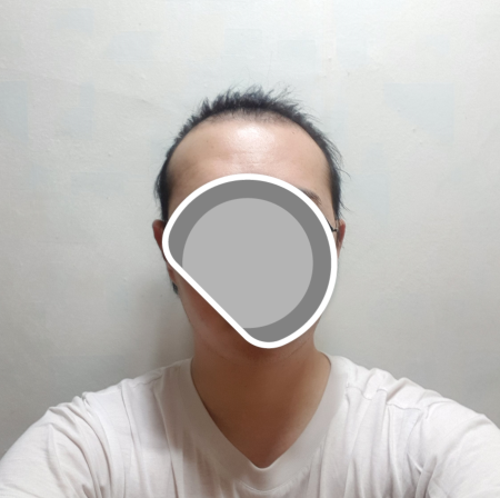수술 전 정면