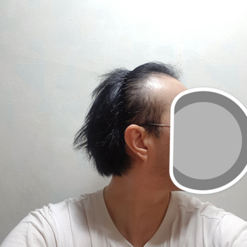 수술 전 우측