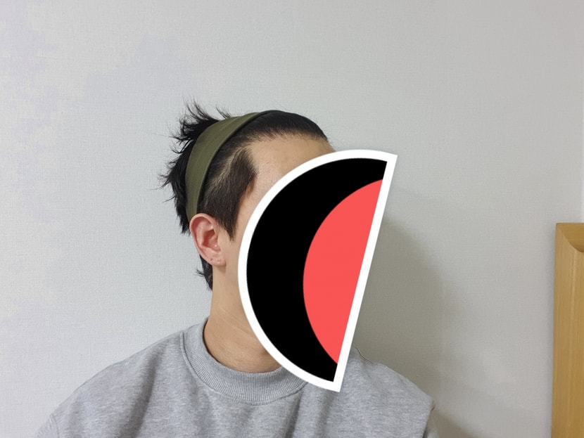 모발이식 전
