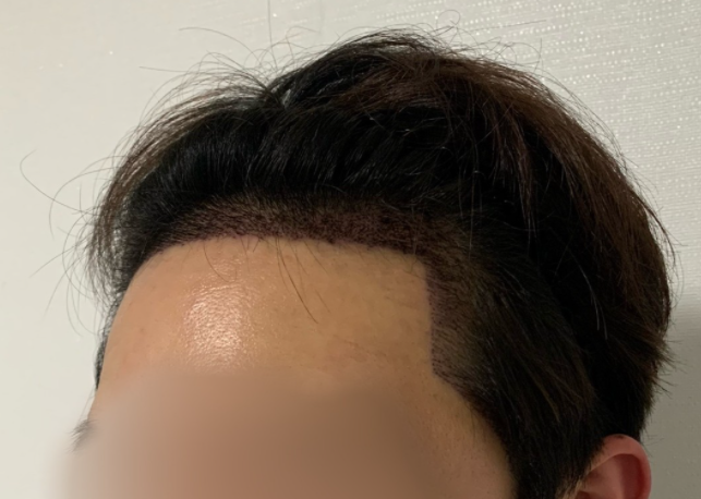 모발이식 후