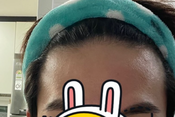 모발이식 전