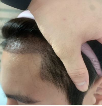 수술 후
