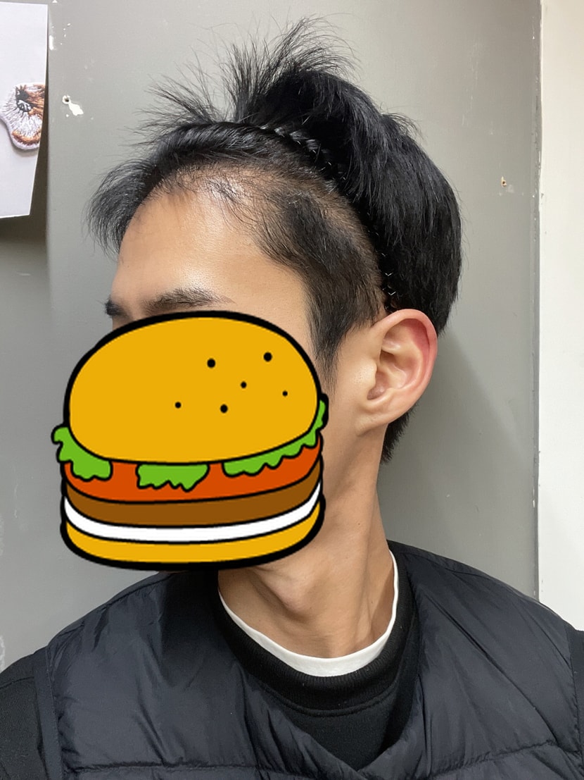 수술 후 6개월