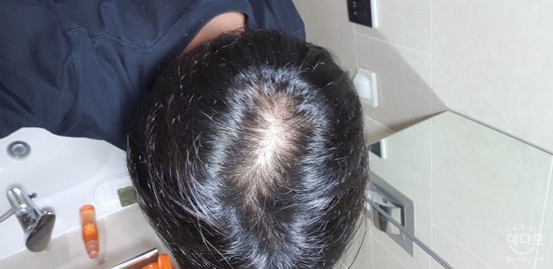 정수리 1800모 8개월차 후기올립니다.