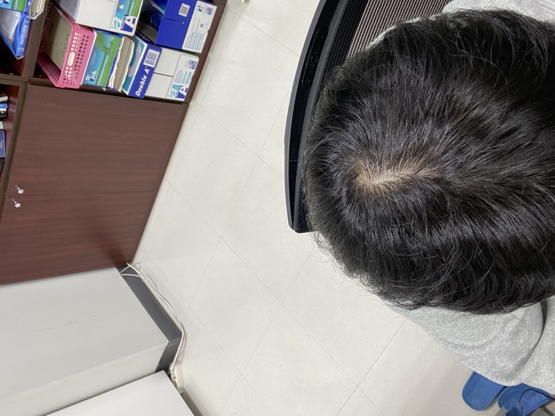 27살 프페 카피약 6년 복용 후기 및 고민