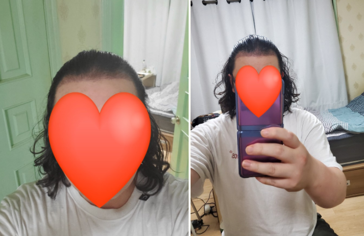 수술 하고 3개월 입니다