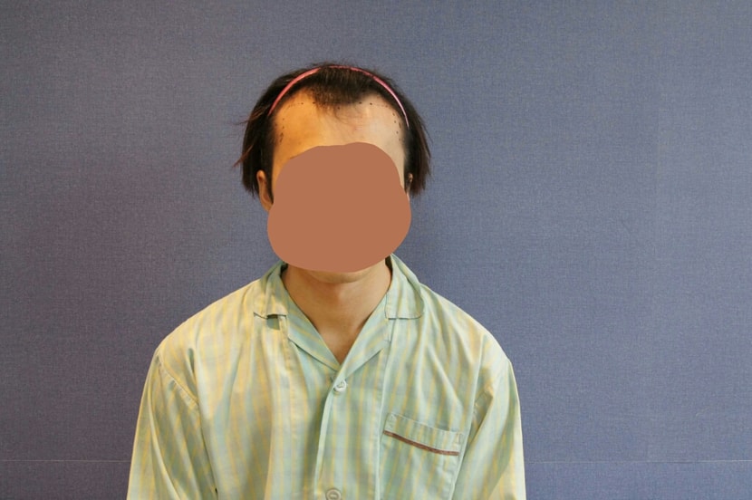 모발이식 전 사진