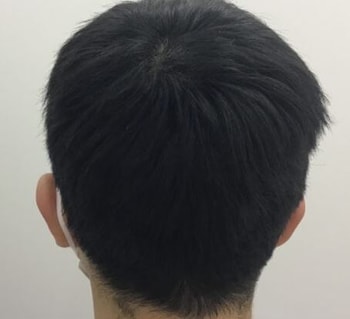 약 복용 후 (3개월전)