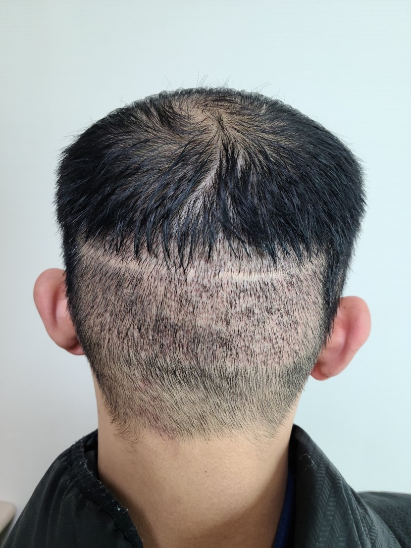 2차 수술 후 사진