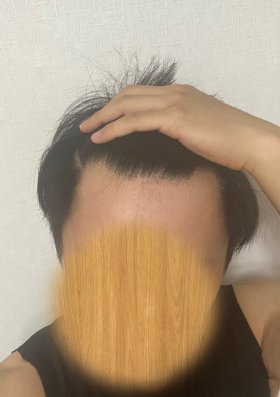 모발이식 전