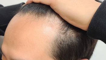 수술 전