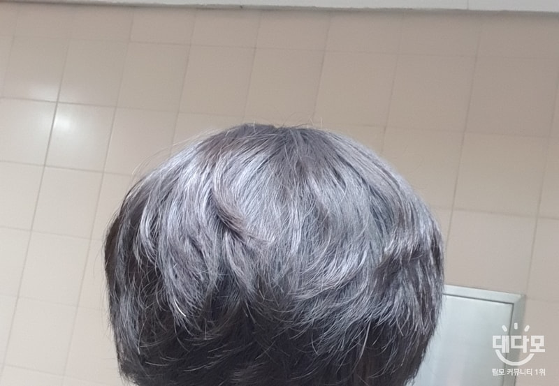 탈모약 3년 먹었는데 이상하게 그대로네요.. 정수리탈모 ㅠㅠ 도와주세요