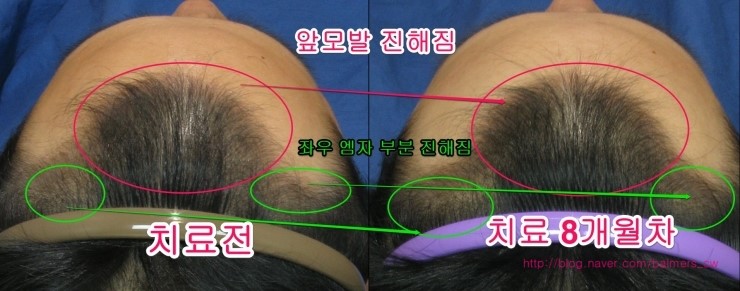 모 한의원 8개월 성공후기(저아님)