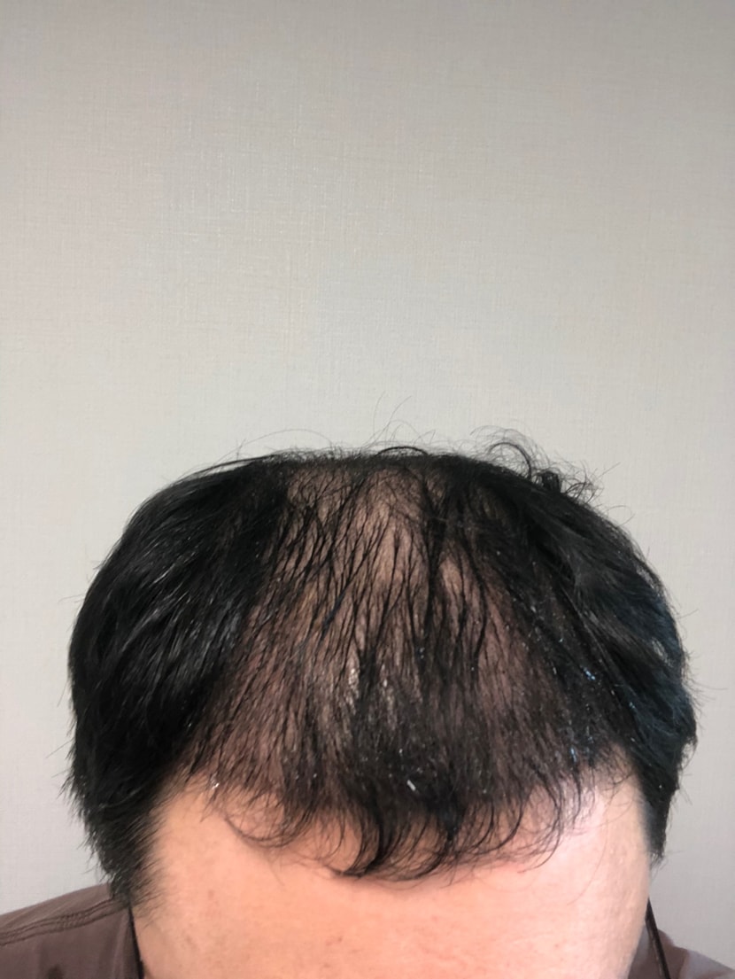모발이식 후 사진이에요 (현재)