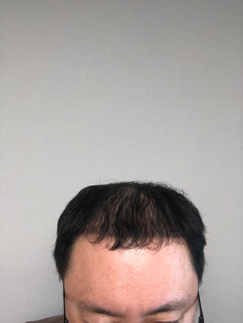 모발이식 후 사진이에요 (현재)