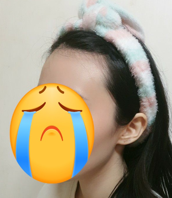 모발이식 전 사진입니다