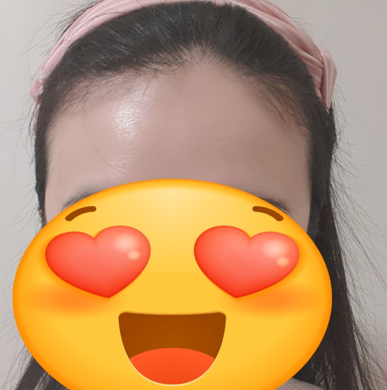모발이식 후 사진입니다