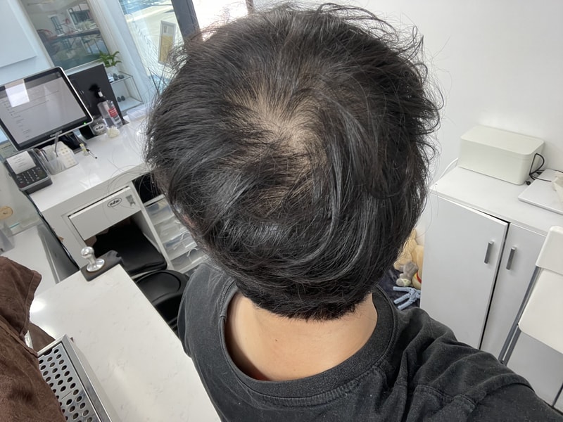 대전 탈모진단 어디로 가야하나요 ㅠㅠ 탈린이의 슬픔