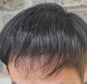 후