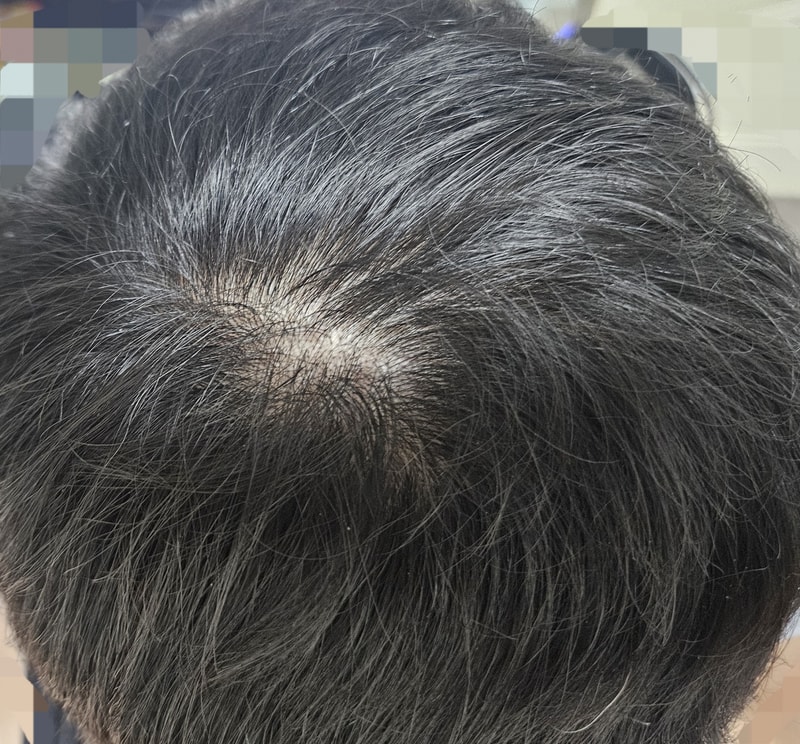 薄毛でストレスを受けたらいけないのに、 すごく受けますね