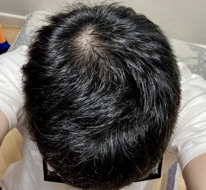 비포