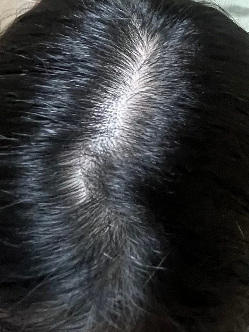 20대 여성인데 주사치료랑 먹는약 치료중에 뭐가 괜찮을까요?!