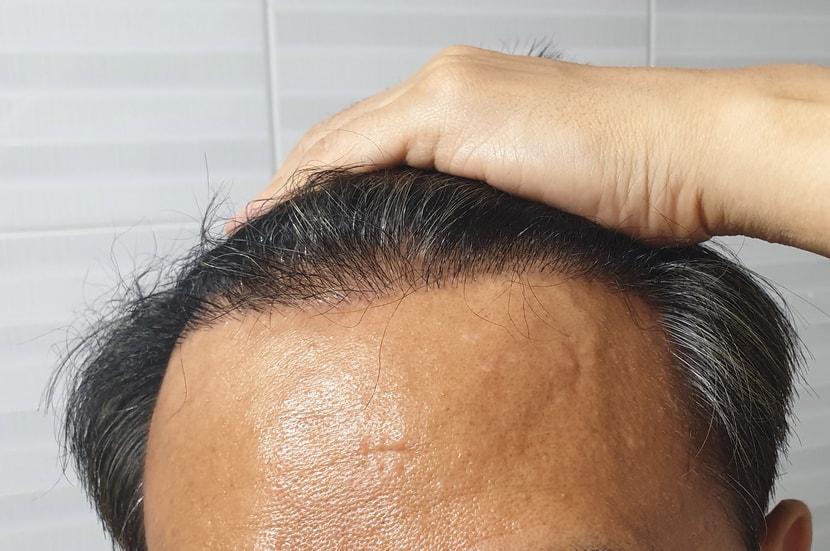 수술후