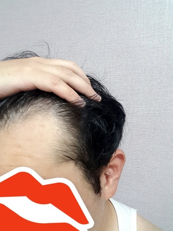 수술전